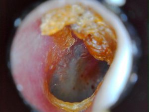 earwax treatments